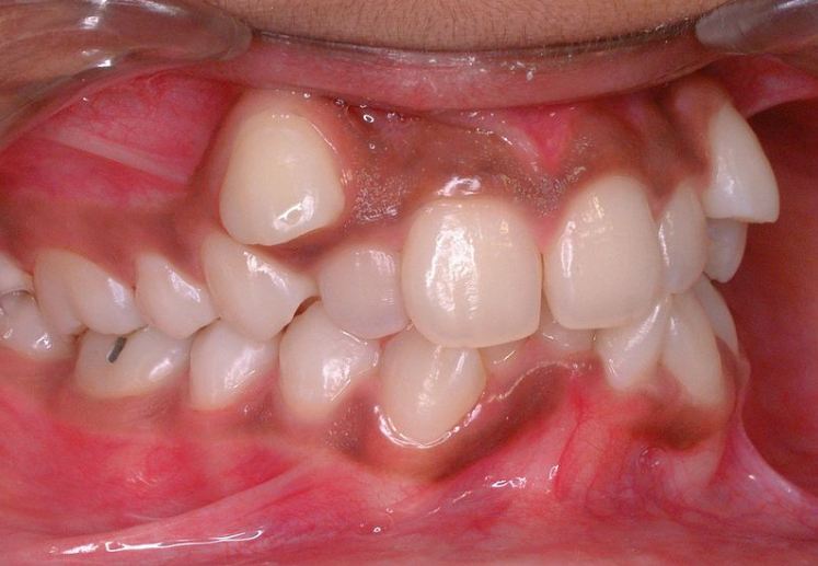 Crooked Teeth are Not Considered Ugly