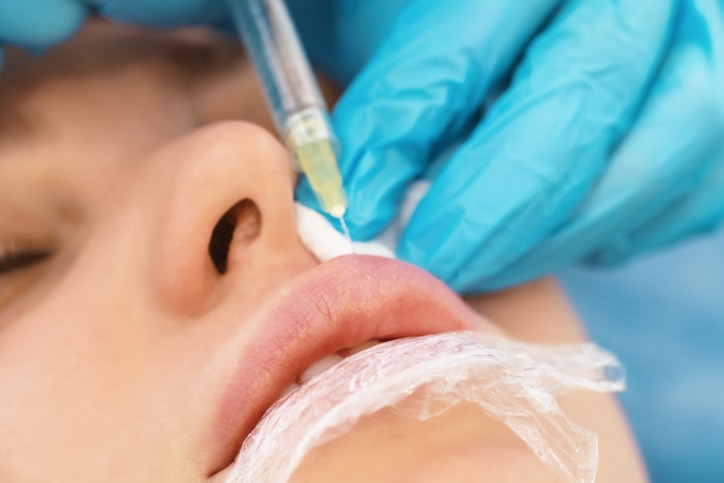 Tips for San Diego Residents Getting Lip Fillers for the First Time